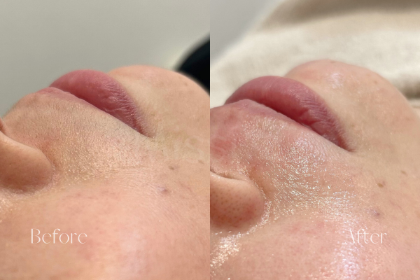 ミッシーズのフェイシャルワックス口周り