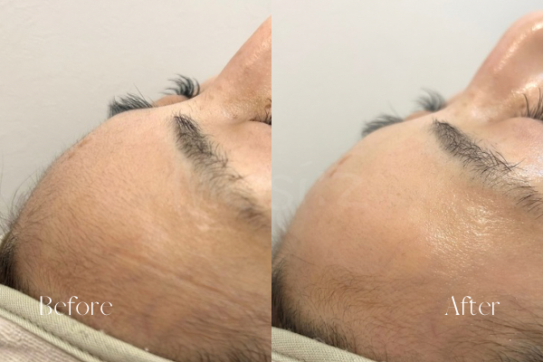 ミッシーズのフェイシャルワックスおでこ