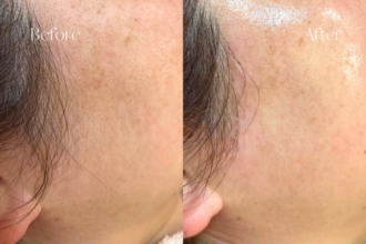 顔の産毛をなくすと何が起きる？プロが教える「ワックス脱毛」4つのメリット